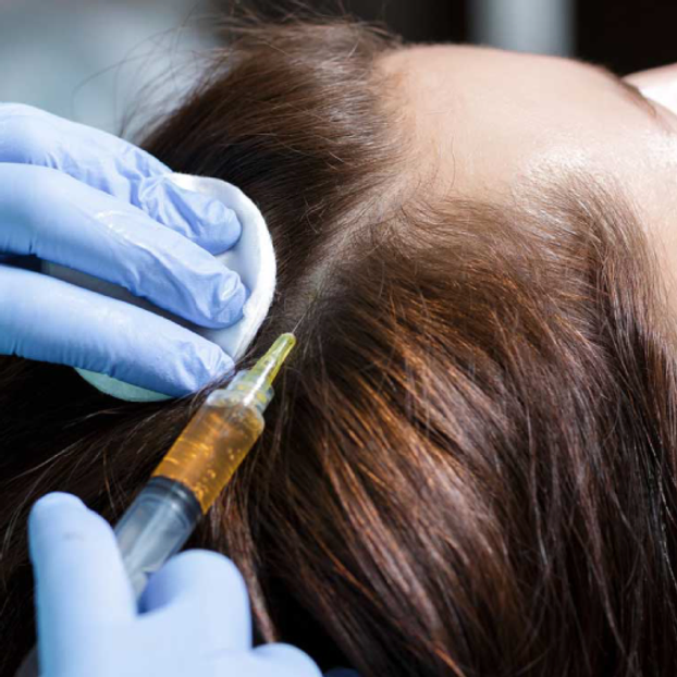PRP Therapy for Hair Loss (Platelet-Rich Plasma)